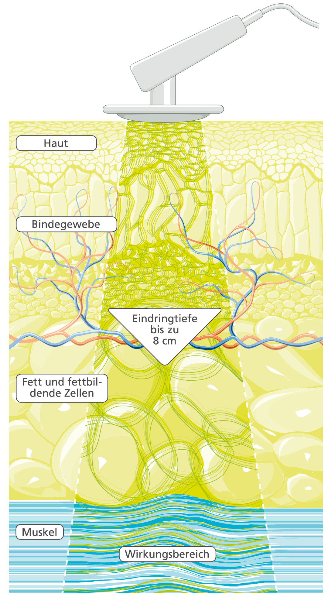 Hivamat 200 - Evident ECO - Deep Oscillation inkl. Standardzubehör! (Gerätewagen optional!) - Artikel NICHT mehr lieferbar!